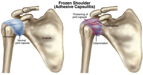 Frozen-shoulder-2
